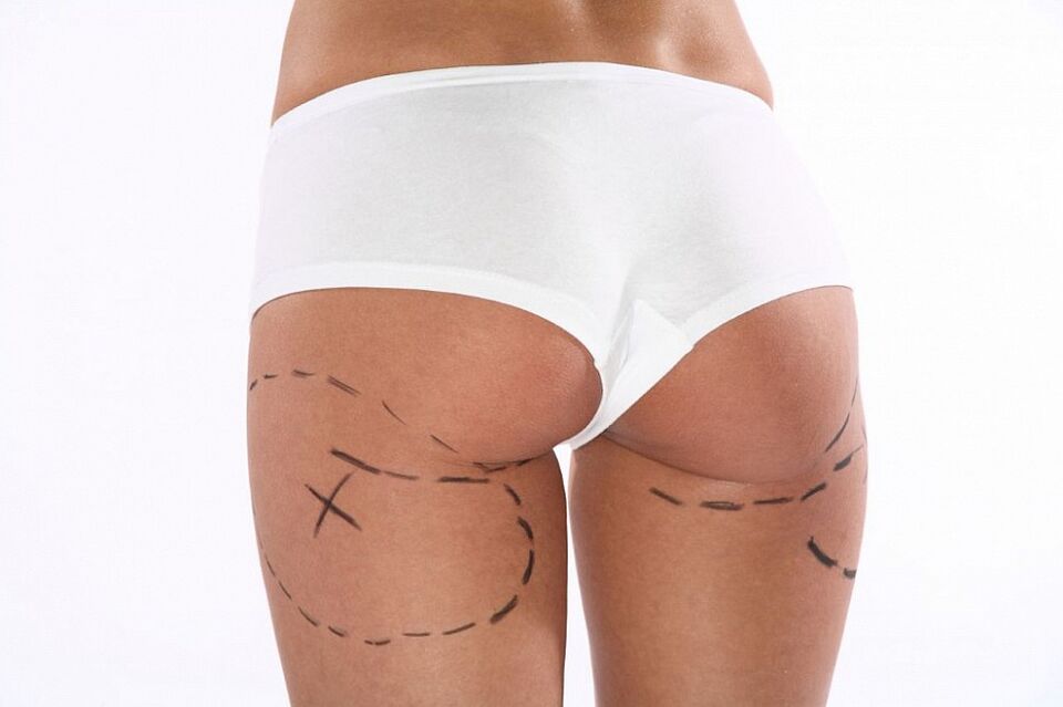 cosmetische procedures voor gewichtsverlies